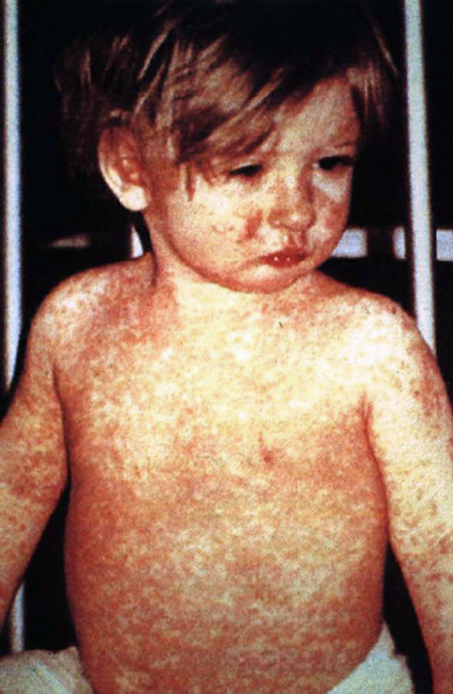 O sarampo pode ser mortal para crianças pequenas.(Foto: CDC/NIP/Barbara Rice)