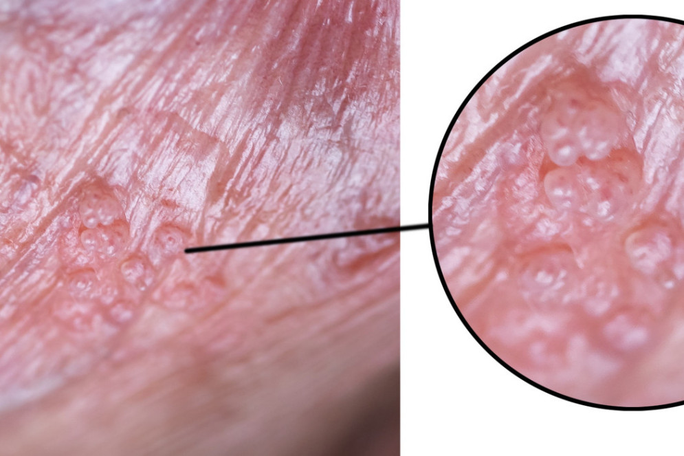 Lesão cutânea por vírus do papilomavírus humano HPV(Foto: parilov / adobe stock)