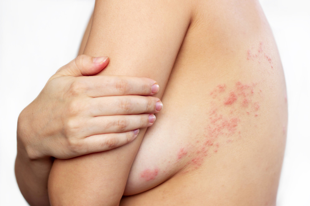 Bolhas causadas por herpes zoster no corpo de uma jovem: comichão e vermelhidão nas costas (Foto: AdobeStock)