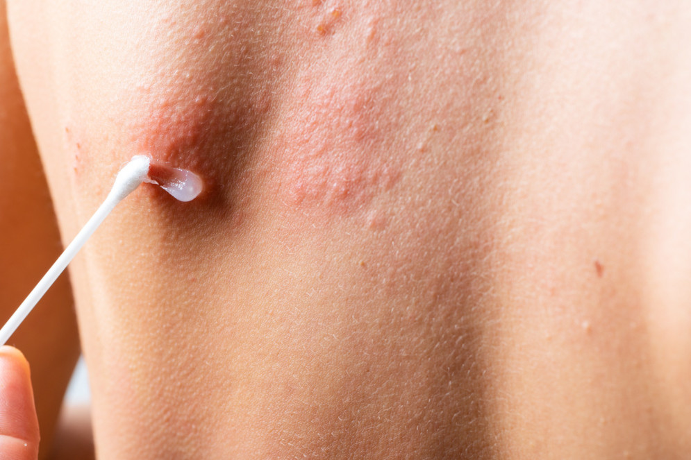 Erupção cutânea e bolhas no corpo causada pelo vírus Herpes-zoster . Além das bolhas no corpo, dores muito fortes, dificuldade para se mover, dormir ou mesmo tomar banho são alguns dos sintomas associados ao HZ(Foto: AdobeStock)