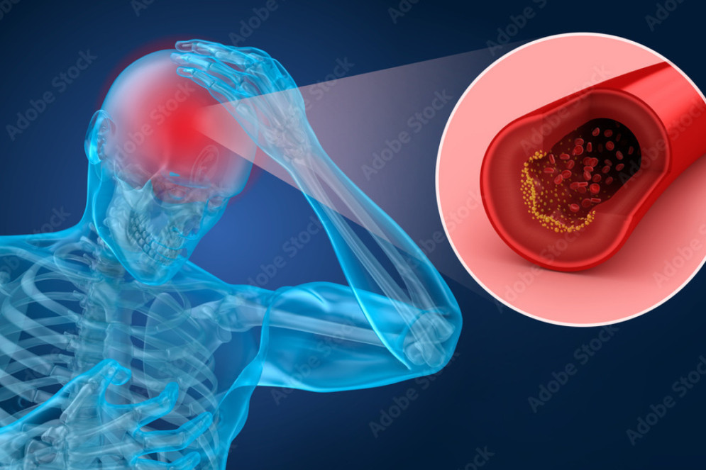 Estudo da Sociedade Brasileira de Angiologia e Cirurgia Vascular revela que, entre 2019 e junho de 2024 o número de mortes por AVC ultrapassou o número de mortes por Infarto Agudo no Miocárdio(Foto:  AdobeStock)