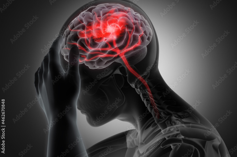 O Dia Mundial do Acidente Vascular Cerebral,em 29 de outubro, se propõe a alertar para prevenção e riscos da doença(Foto: utah51 / adobestock)