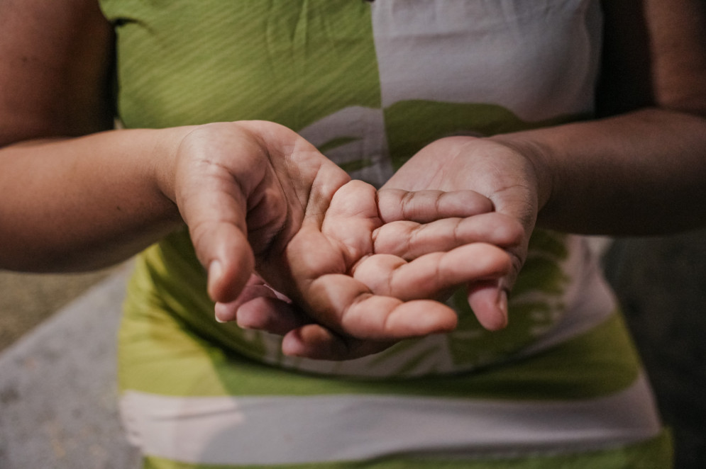 O nome científico da doença é Lúpus Eritematoso Sistêmico (LES) e uma das características mais presente é a mancha na face "em asa de borboleta"(Foto: FERNANDA BARROS)