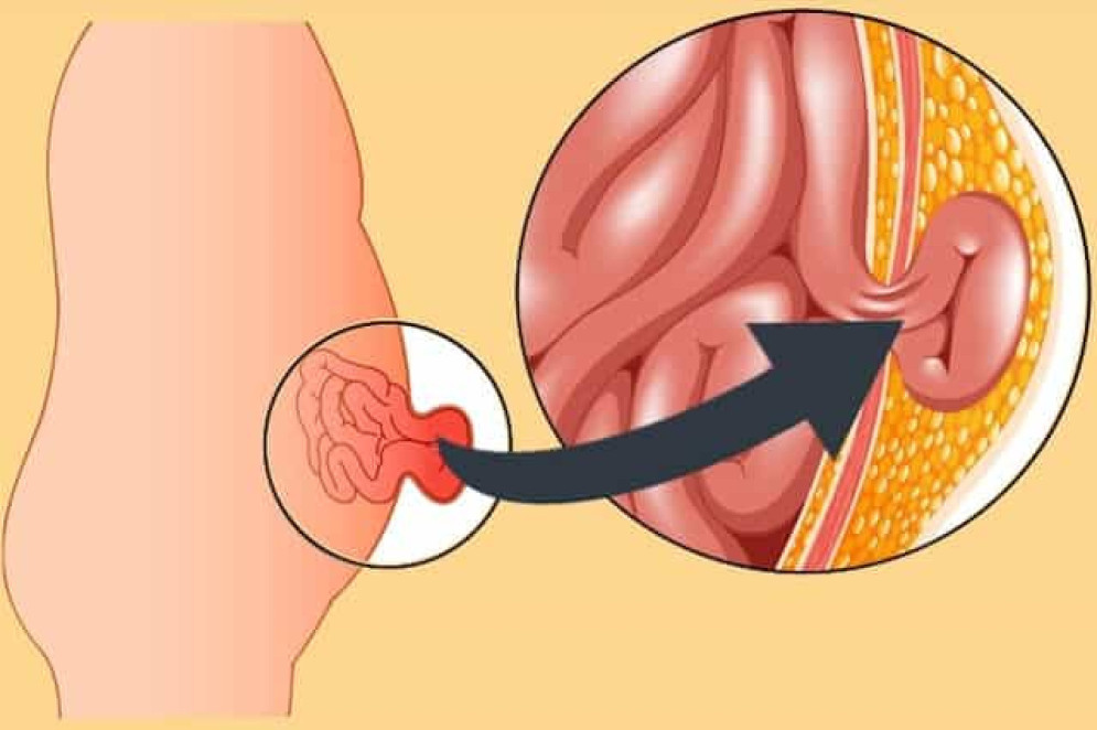Hérnia abdominal é o escape (protusão) parcial ou total de um ou mais órgãos por um orifício que se abre, por má formação ou por enfraquecimento nas camadas de tecido protetoras dos órgãos internos do abdômen. Entre os tipos mais comuns está a hérnia umbilical, que manifesta-se como na imagem(Foto: Reprodução/Sociedade Brasileira de Hérnia (SBH))