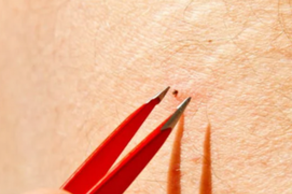 Nunca esmague o carrapato.