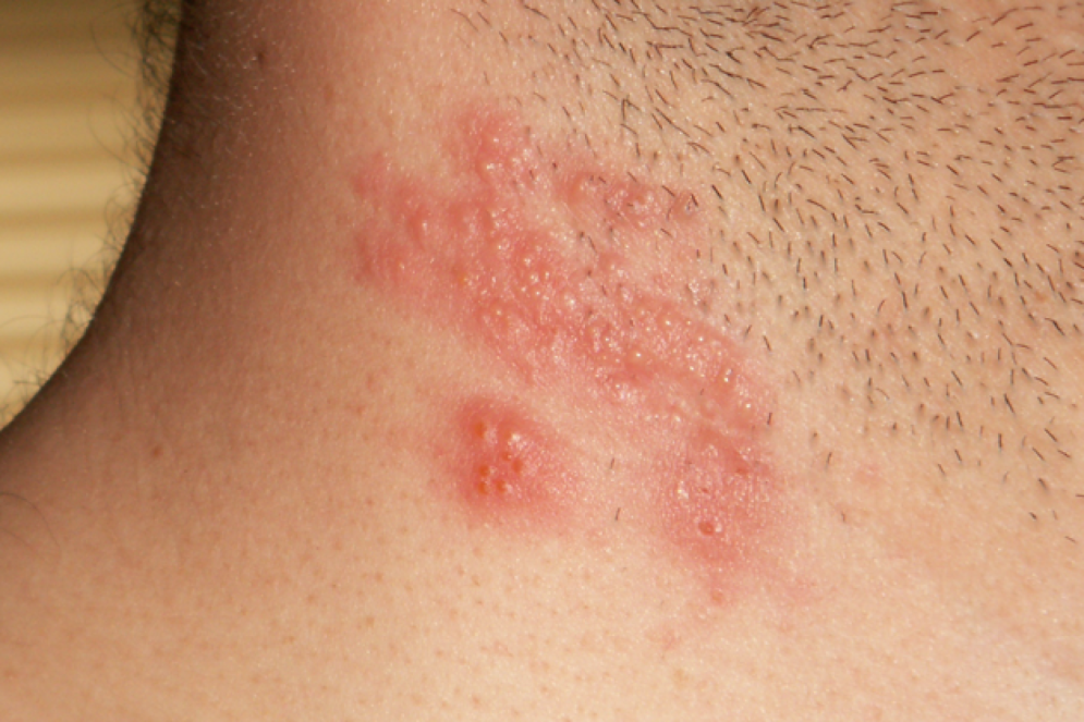 Bolhas de herpes zoster no pescoço e ombros(Foto: John Pozniak/Wikimedia Commons)